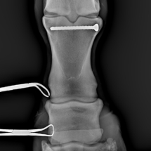 P1 short sagittal fracture